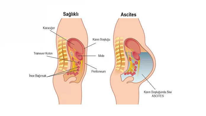 Asit Ascites Nedir